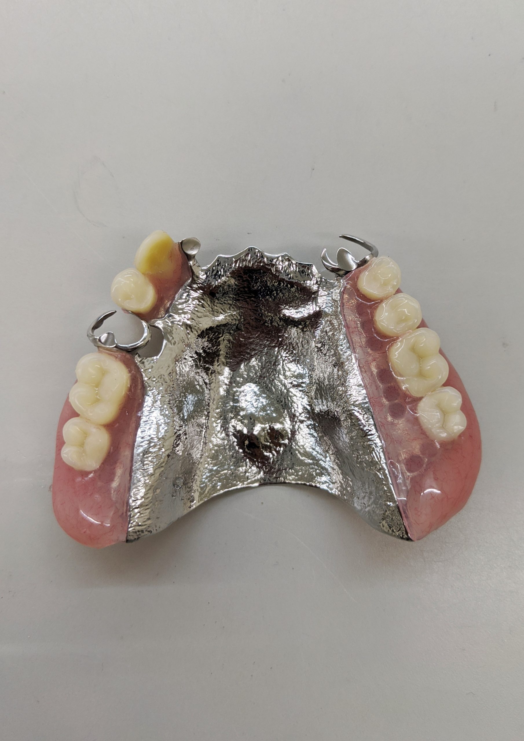 金属 床 による 総 義歯 の 提供