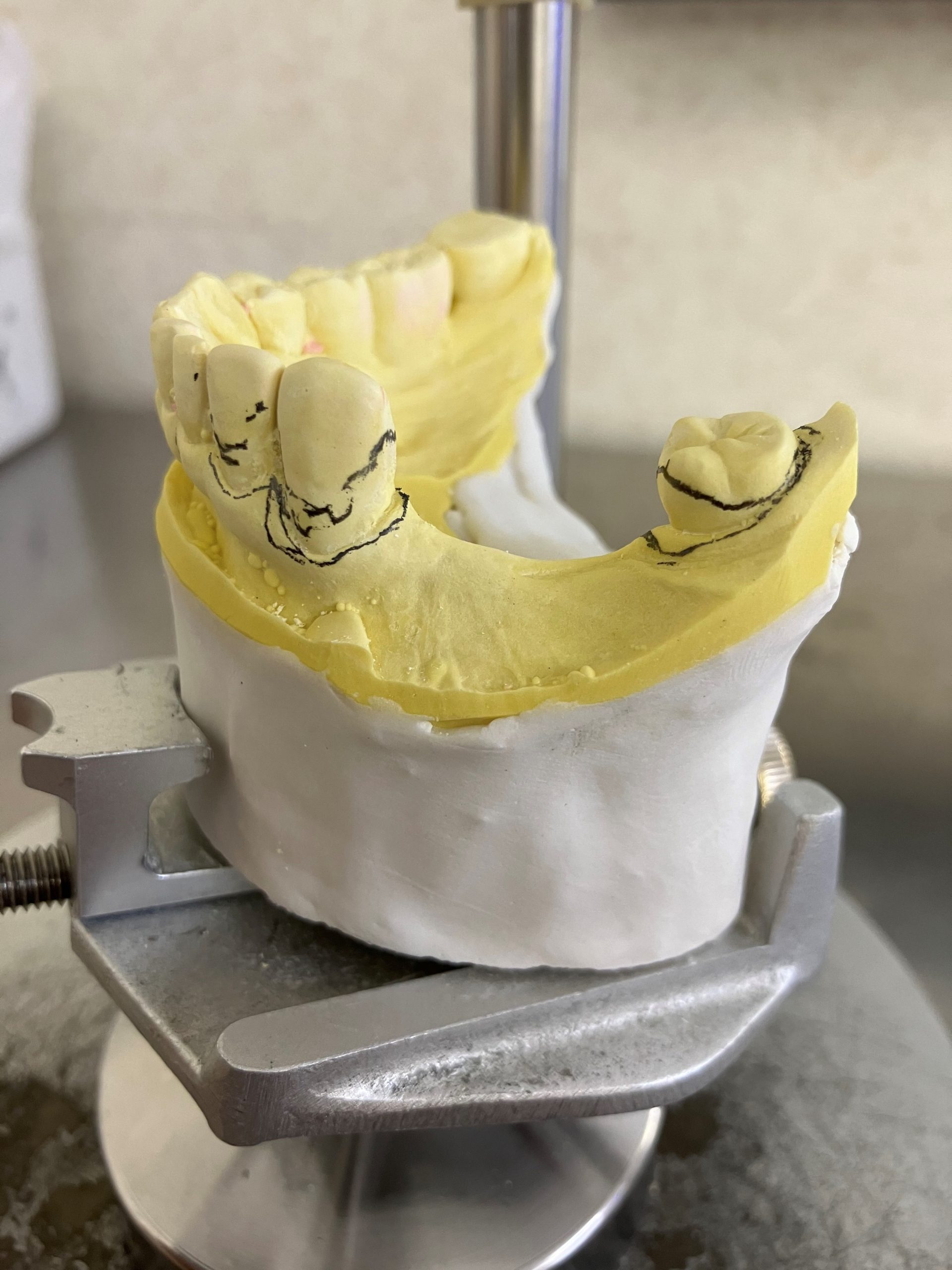 義歯の着脱について | G-REX（ジーレックス）｜新潟にある義歯を製作