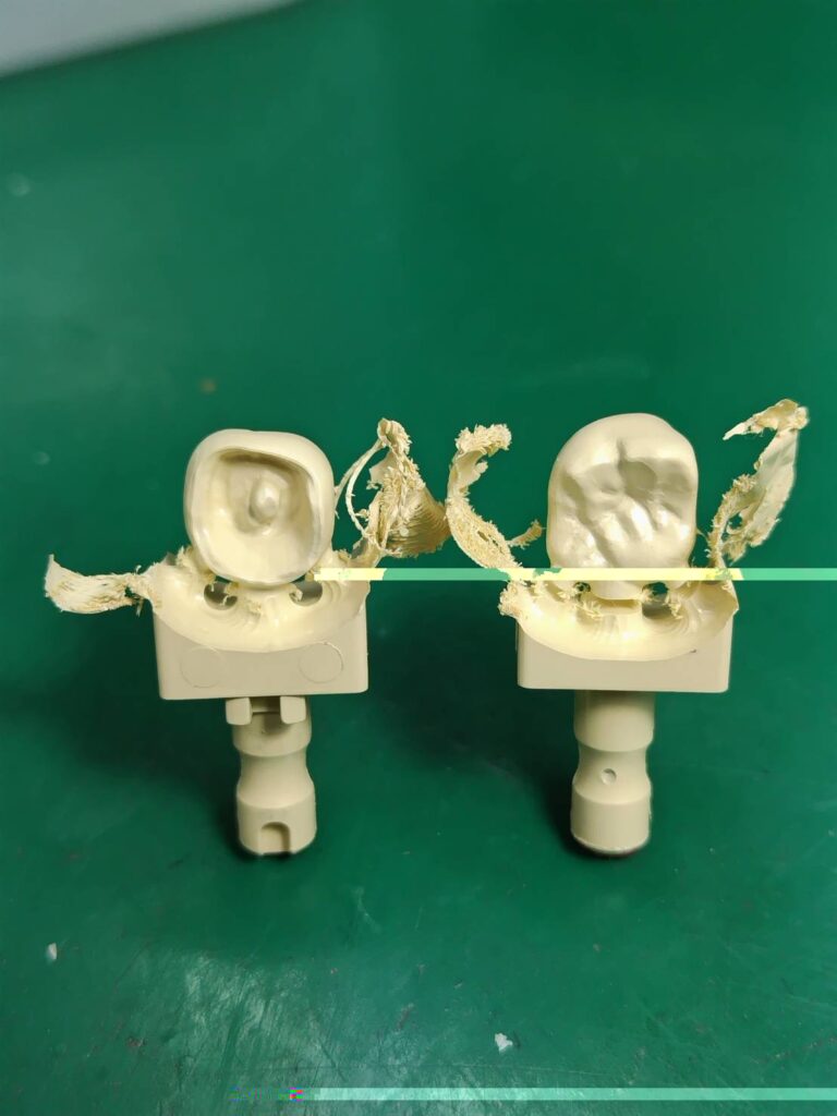 CAD/CAMタイプⅤ PEEK冠 | G-REX（ジーレックス）｜新潟にある義歯を